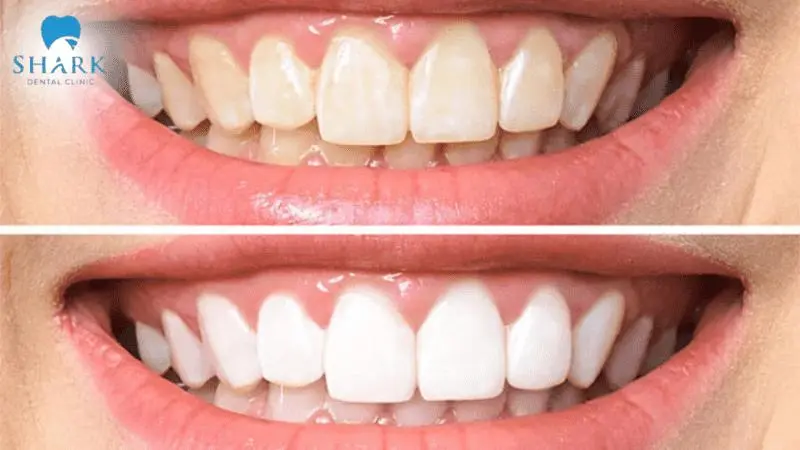 Bột làm trắng răng giúp loại bỏ vết bám trên răng