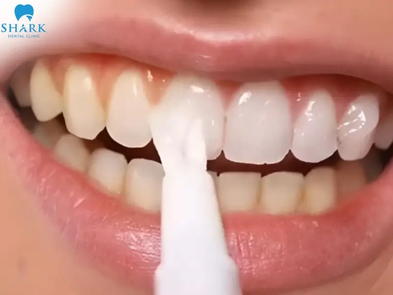 Tẩy trắng răng không đều màu