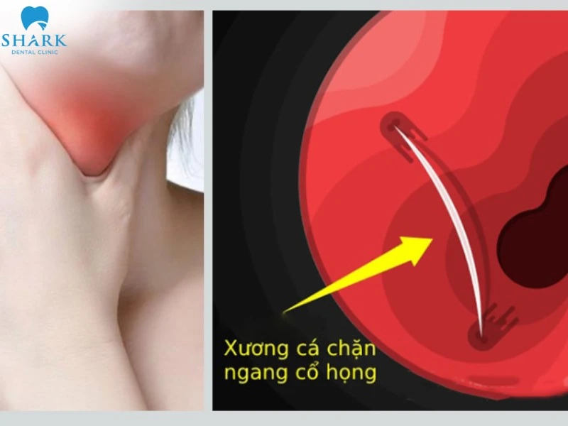 Hóc xương cá là tình trạng xương cá mắc kẹt tại vùng họng, gây cảm giác đau rát, khó chịu