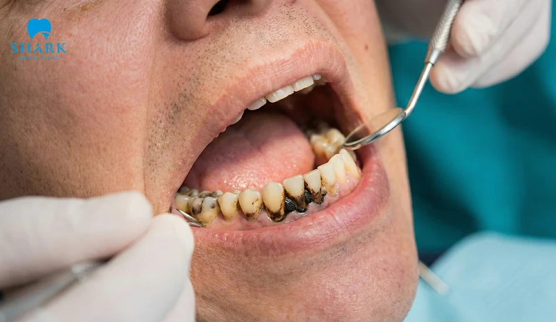 Sâu răng là nguy cơ gây nên tình trạng cao răng đen