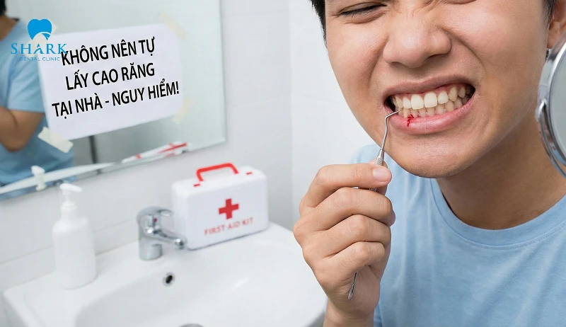 Không được tự ý lấy cao răng đen ở nhà