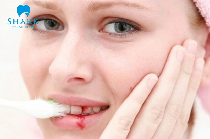 Vệ sinh cẩn thận để không làm chảy máu răng