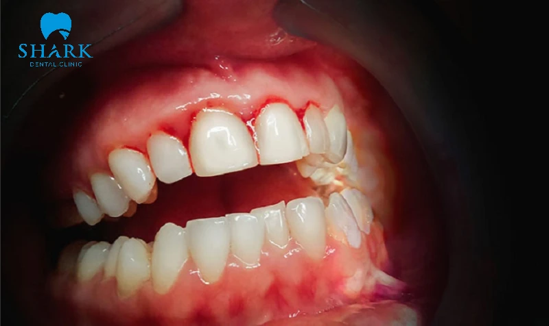 Nướu răng chảy máu liên tục 2 tuần mà không dứt