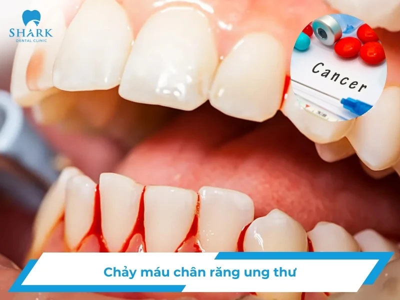 Chảy máu chân răng ung thư: Liệu có phải là sự thật không? 13 Chảy máu chân răng ung thư