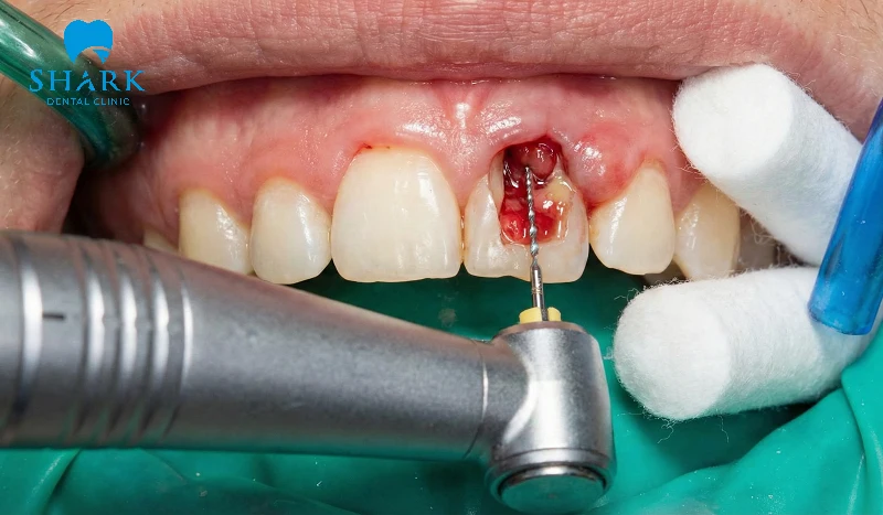 Điều trị tủy răng cửa