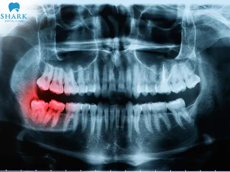 Chụp Panorama để kiểm tra tình trạng răng khôn