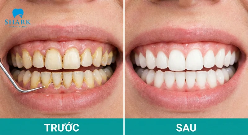 Hình ảnh nụ cười rạng rỡ, răng trắng sáng sau khi được vệ sinh