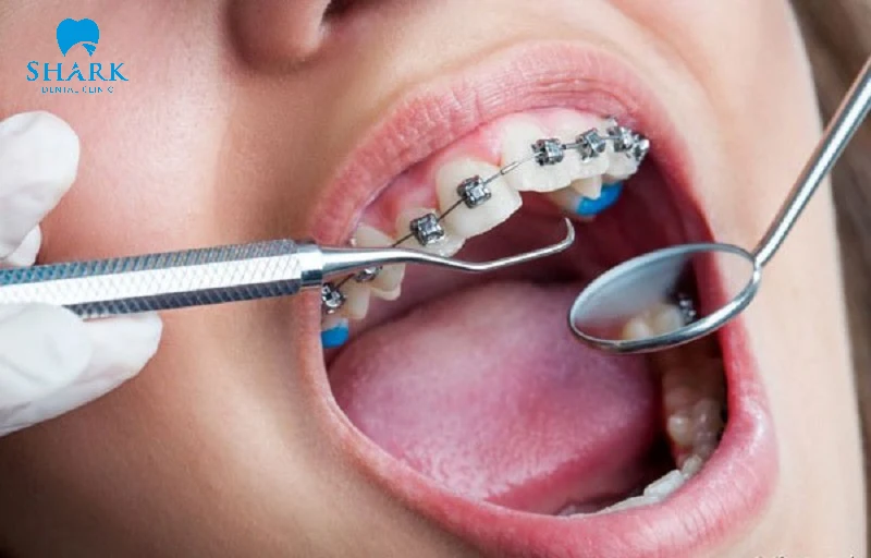 Bác sĩ nha khoa đang thực hiện cạo vôi răng cho bệnh nhân đeo mắc cài