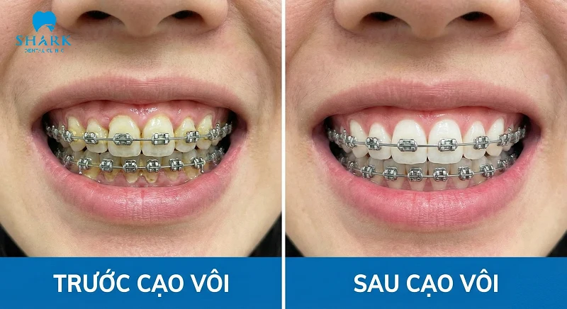 Hình ảnh so sánh răng trước và sau khi cạo vôi ở người niềng răng