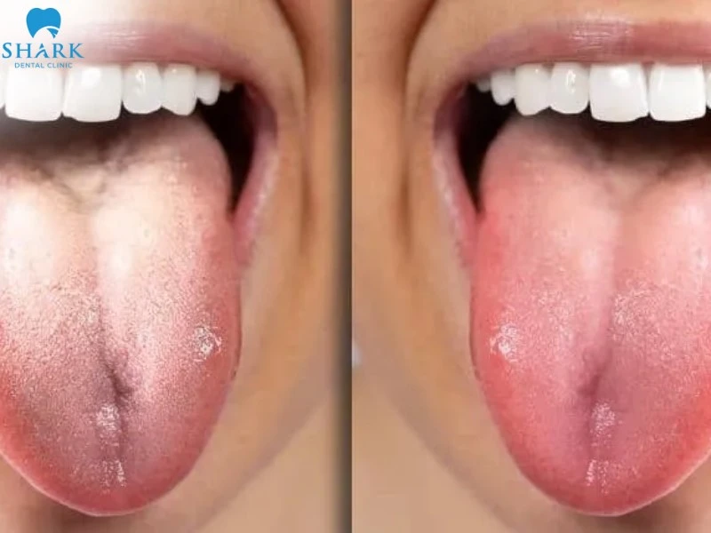 Viêm gai lưỡi thông thường