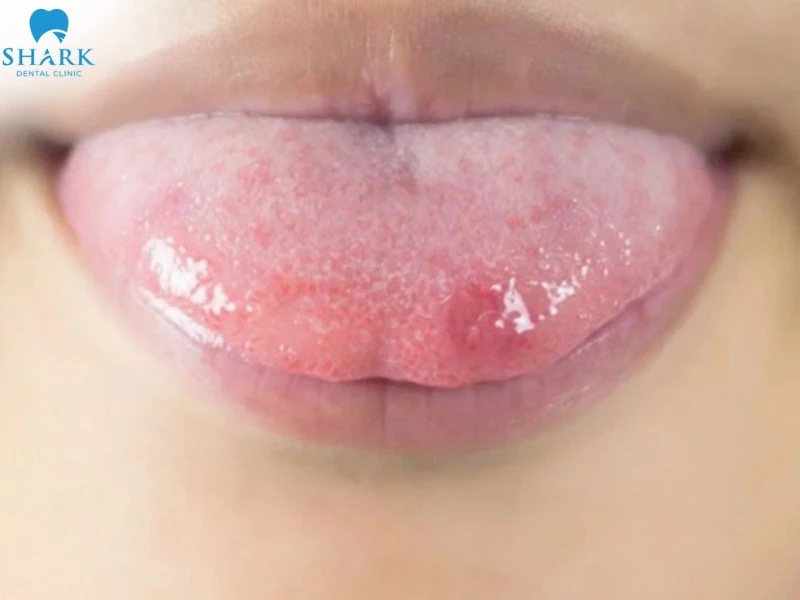 Lưỡi có mụn nước khó chịu