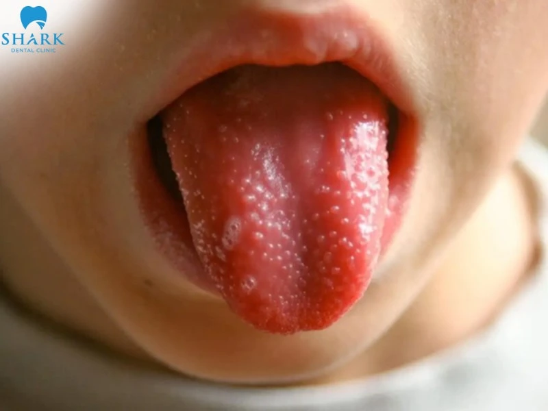 Hình ảnh viêm gai lưỡi đỏ và nổi hạt