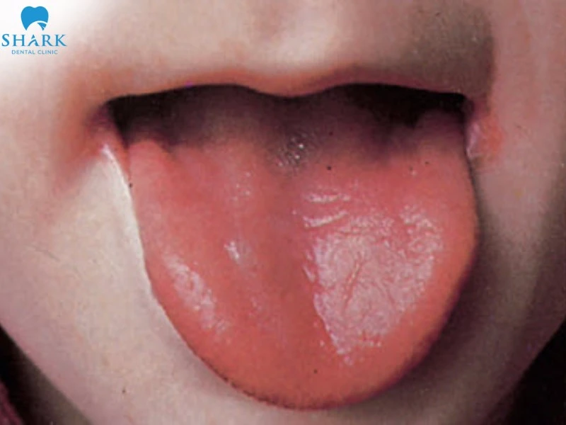 Viêm gai lưỡi làm thay đổi màu sắc của lưỡi và lưỡi trơn láng