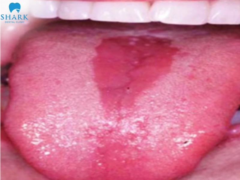 Hình ảnh viêm gai lưỡi nóng rát