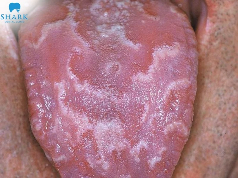 Hình ảnh viêm gai lưỡi bản đồ