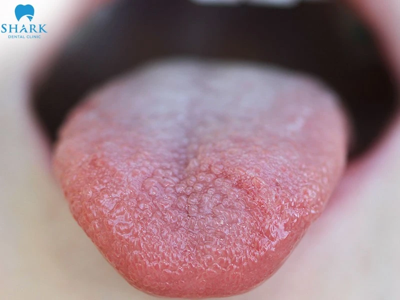 Hình ảnh viêm gai lưỡi phát ban