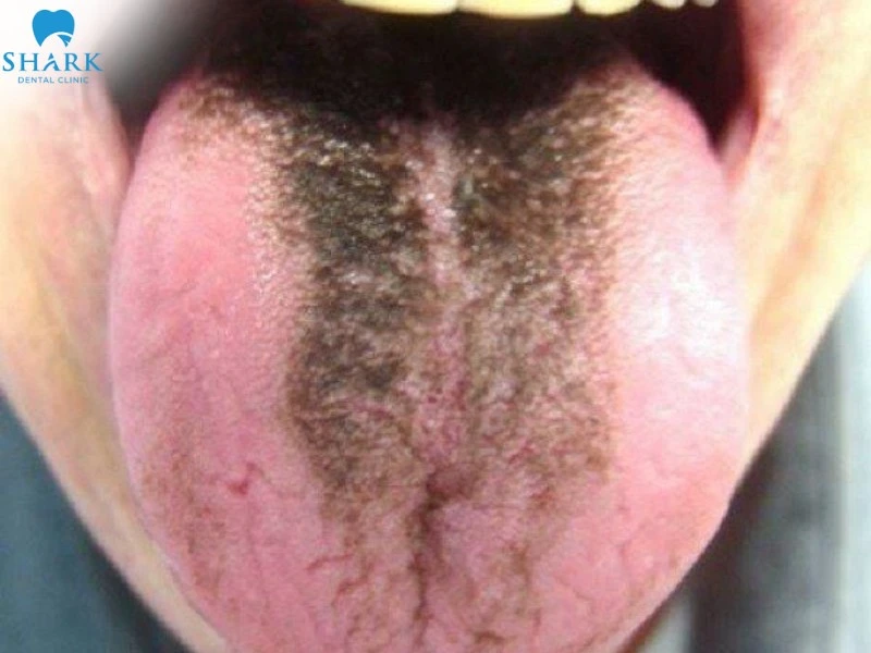 Lưỡi bị nhiễm trùng do vi khuẩn tích tụ lâu ngày