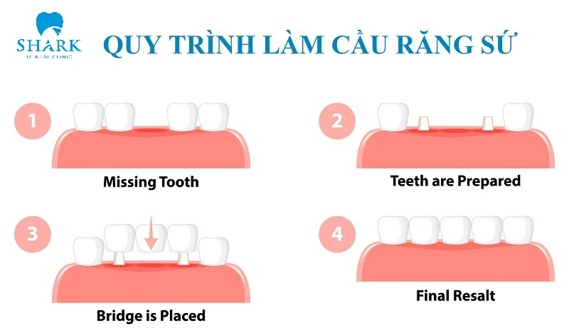 Giá làm cầu răng sứ bao nhiêu tiền? Bảng giá mới 2025 18 Quy trình làm cầu răng sứ