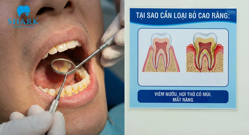 Lý do cần phải lấy cao răng sớm