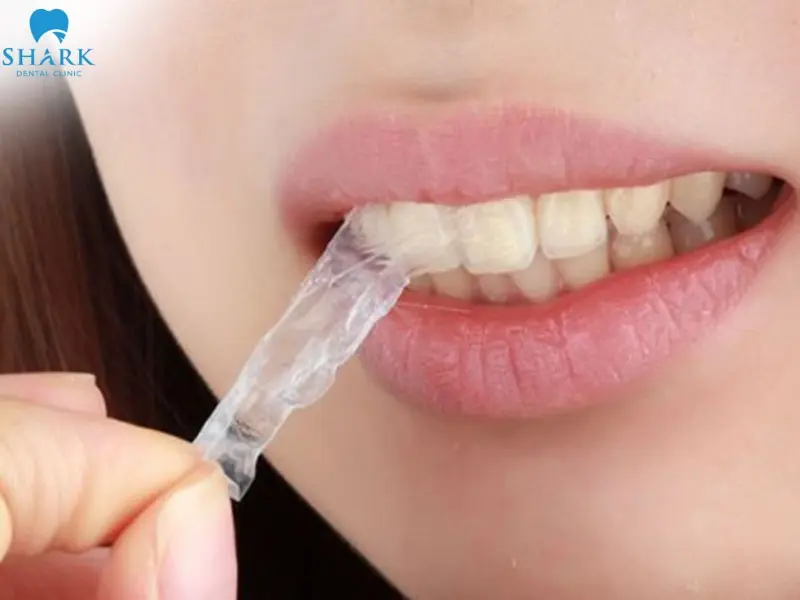 Miếng dán trắng răng không ôm sát vào kẻ răng