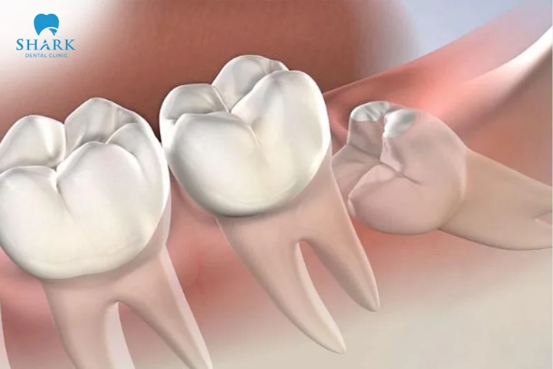 răng khôn hàm dưới mọc lệch