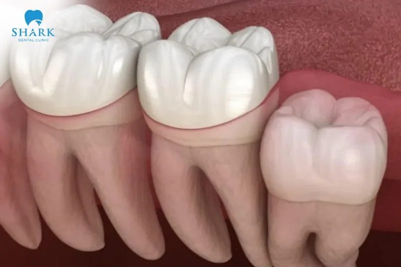 răng khôn mọc thẳng