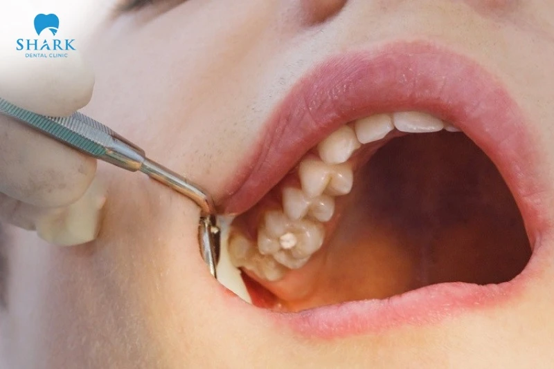 Mọc răng khôn hàm trên: Những vấn đề thường gặp và cách xử lý an toàn 11 thời điểm mọc răng khôn hàm trên