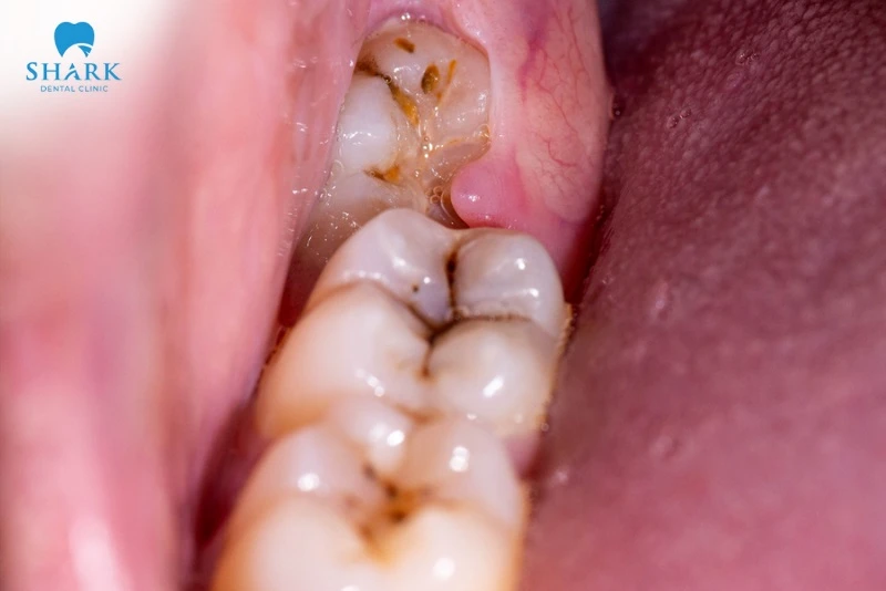 Mọc răng khôn hàm trên: Những vấn đề thường gặp và cách xử lý an toàn 13 răng khôn mọc lệch