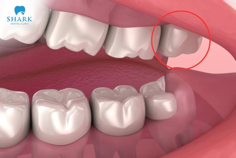 Mọc răng khôn hàm trên: Những vấn đề thường gặp và cách xử lý an toàn 15 răng khôn hàm trên có thể giữ lại nếu mọc thẳng, không gây biến chứng răng miệng