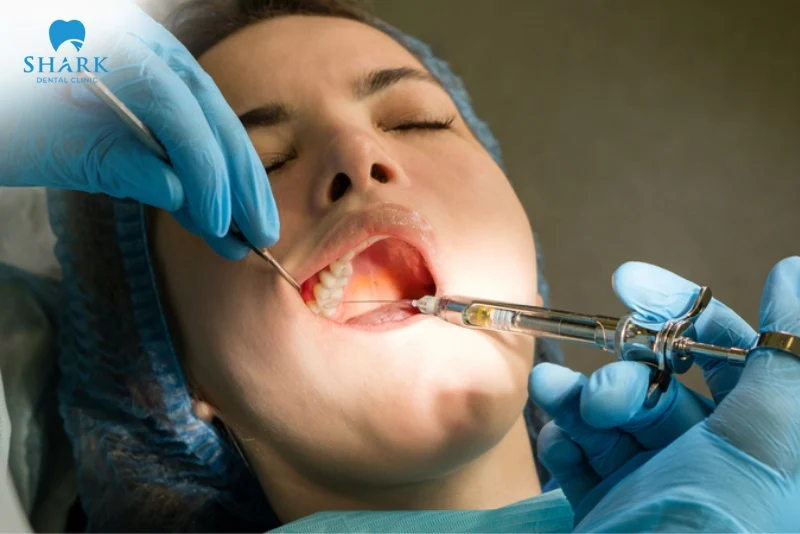 Nhổ răng khôn gây mê là gì? Có nên lựa chọn và cần lưu ý gì? 13 Kỹ thuật nhổ răng khôn gây tê