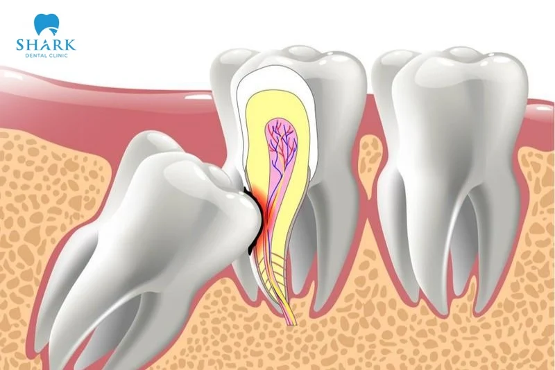 Nhổ răng khôn gây mê là gì? Có nên lựa chọn và cần lưu ý gì? 15 Răng khôn mọc lệch