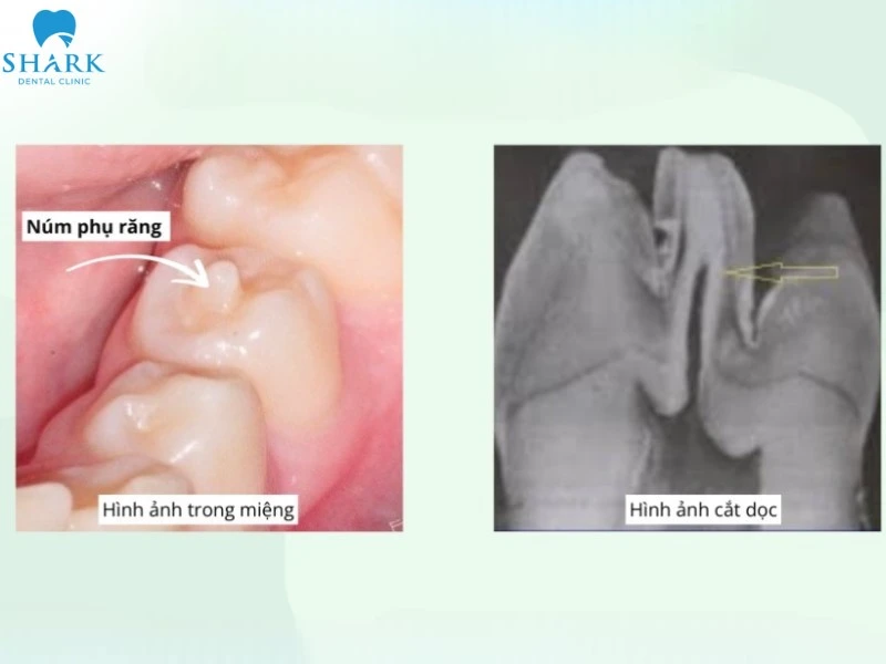 Núm phụ răng là gì? Có ảnh hưởng đến sức khỏe không? 7 Núm phụ răng cũng chứa tủy