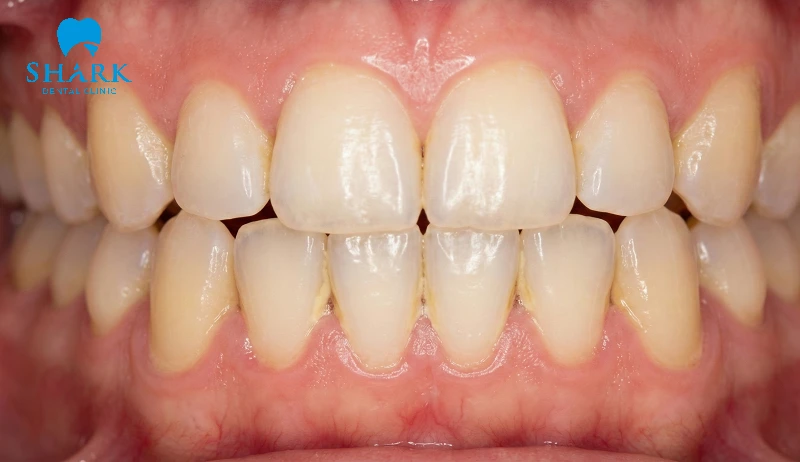 Cao răng cấp độ 1