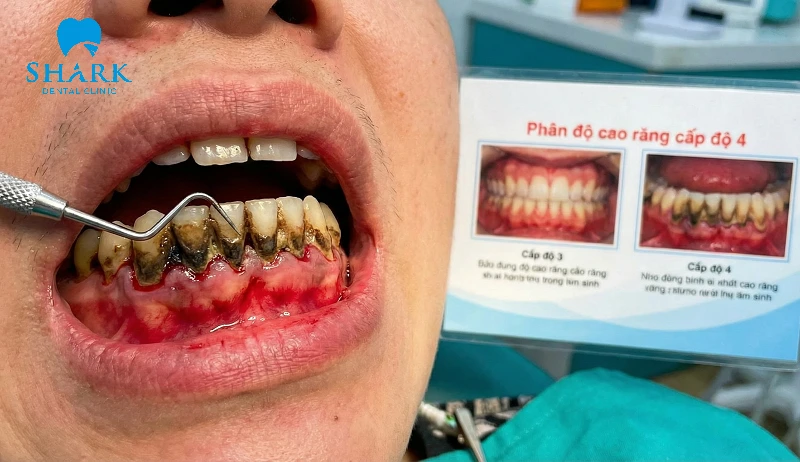 Cao răng cấp độ 4 nguy hiểm