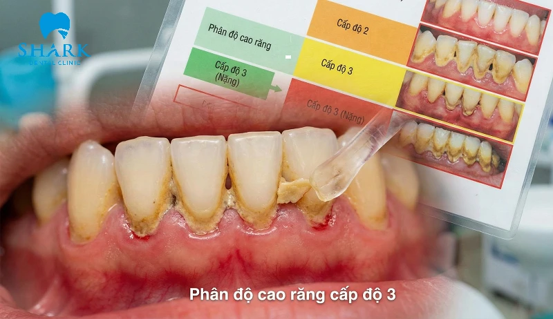 Cao răng cấp độ 3