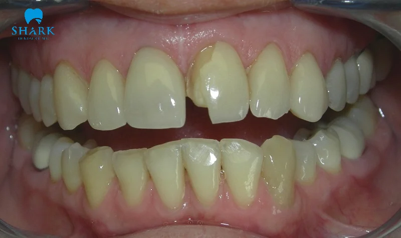 Tại sao bọc răng sứ bị rớt ra? Cách dán răng giả bị rơi ra 11 Răng sứ bị vỡ thì cần không thể tự gắn lại được