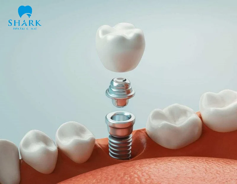 Tại sao bọc răng sứ bị rớt ra? Cách dán răng giả bị rơi ra 14 Cần thay mới trụ Implant nếu vít gãy vỡ
