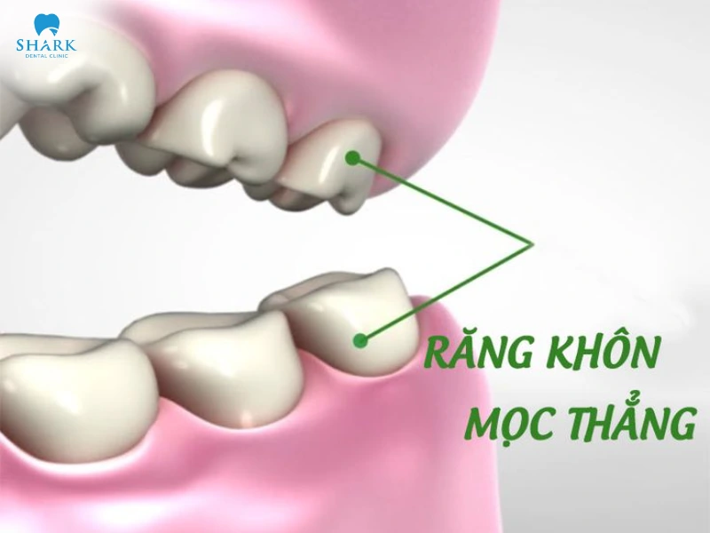 Răng khôn có tác dụng gì? Khi nào nên nhổ răng khôn? 11 Răng khôn mọc thẳng