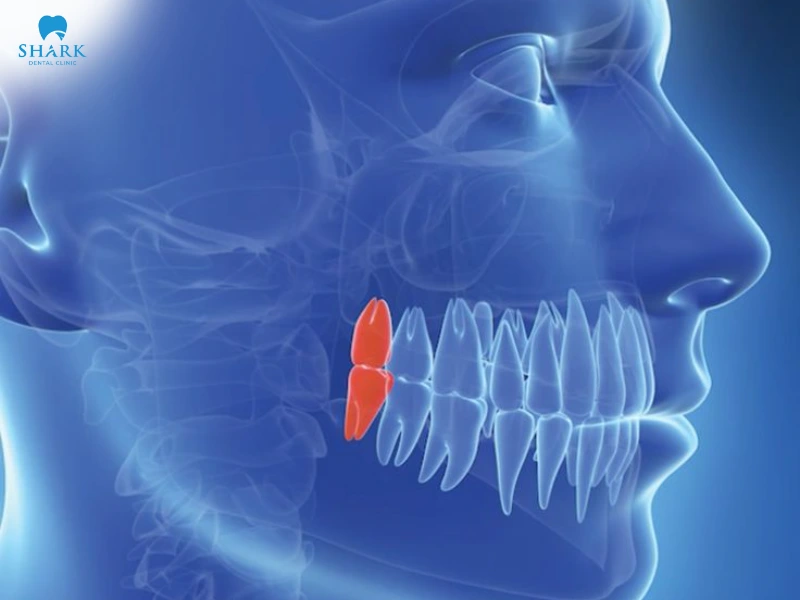 Răng khôn có tác dụng gì? Khi nào nên nhổ răng khôn? 13 Răng khôn mọc thẳng mang lại nhiều tác dụng tốt.