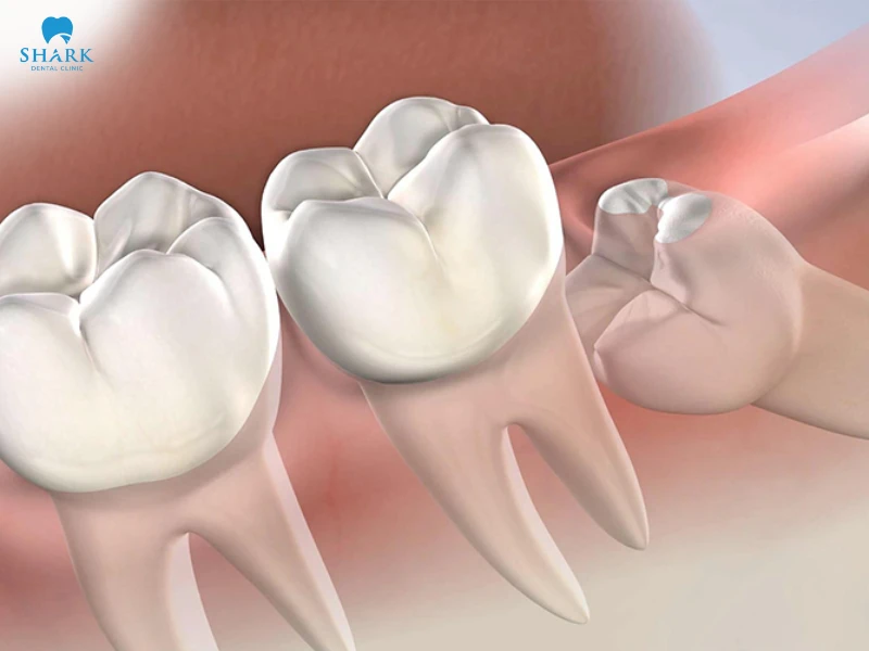 Răng khôn có tác dụng gì? Khi nào nên nhổ răng khôn? 15 Răng khôn mọc lệch.