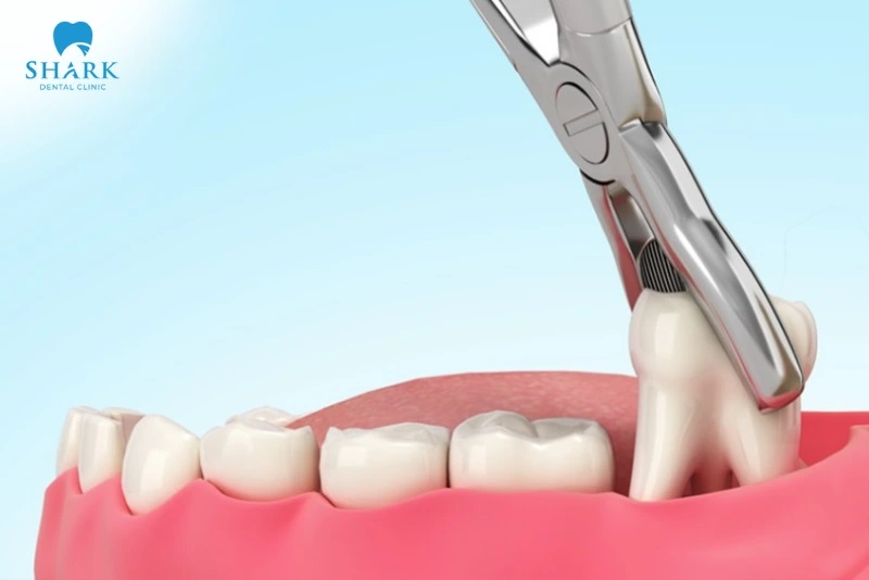 Răng khôn có tác dụng gì? Khi nào nên nhổ răng khôn? 16 Nhỏ bỏ răng khôn hạn chế gây biến chứng.