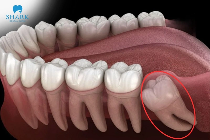 Răng khôn có tác dụng gì? Khi nào nên nhổ răng khôn? 10 Vị trí của răng khôn trên cung hàm