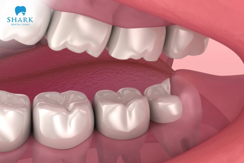 Răng khôn có tác dụng gì? Khi nào nên nhổ răng khôn? 14 Răng khôn mọc xé nướu.