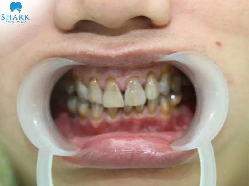 Tình trạng răng nhiễm tetracycline