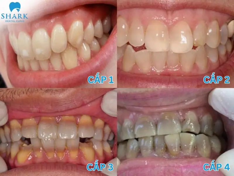 Mức độ răng nhiễm Tetracycline