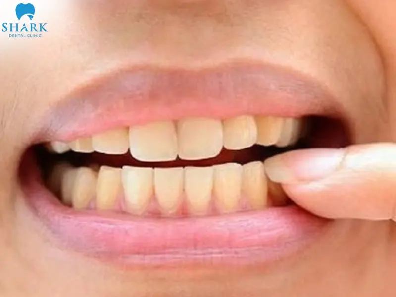 Răng nhiễm Tetracycline khiến răng suy yếu