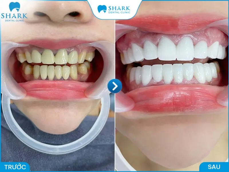 Sử dụng miếng dán sứ Veneer