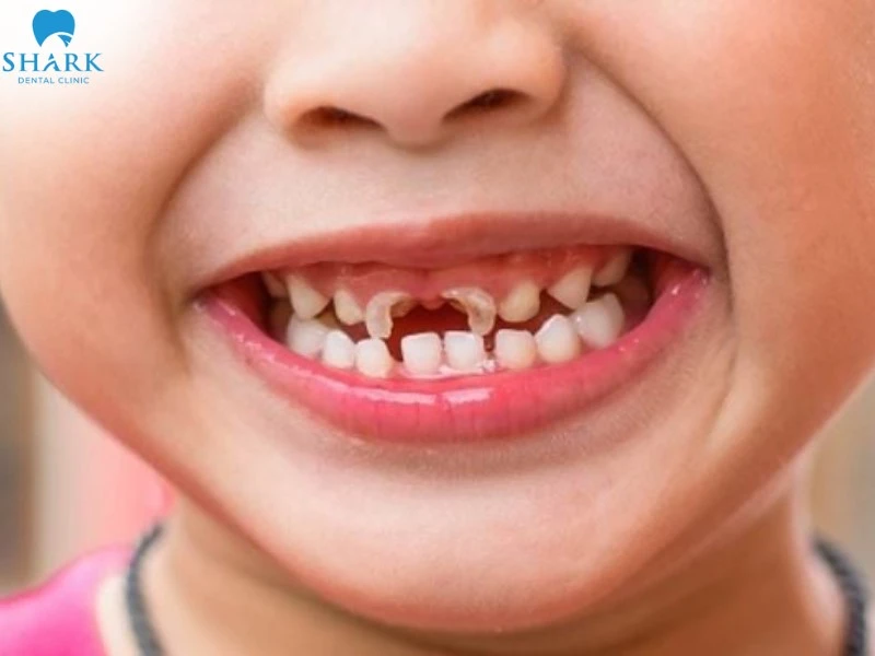 Răng sún ở trẻ