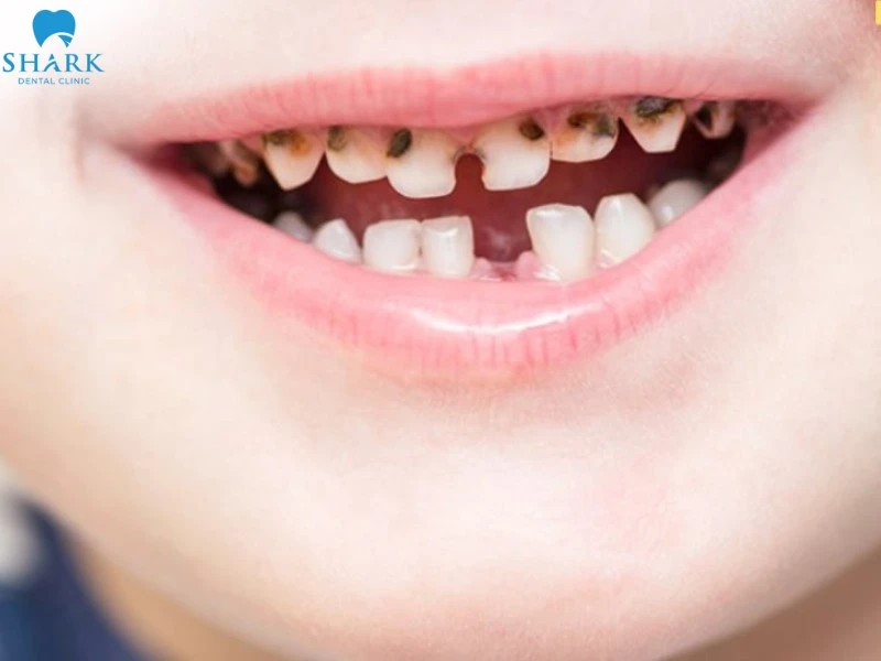 Trẻ bị sún răng khiến cho màu sắc và hình thể răng bị thay đổi nghiêm trọng