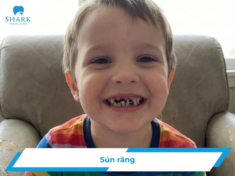 Sún răng